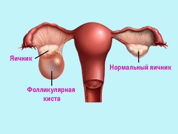 Схема лечения фолликулярных кист